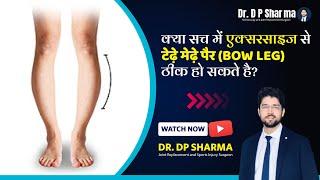 Can Bow Legs Be Corrected With Exercises? Bow Legs Correction In Delhi NCR & Agra - Dr DP Sharma