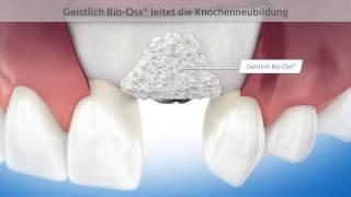 3D-Animation Zahnmedizin: Alveolarwanddefekt Knochenaufbau Oberkiefer (GEISTLICH)