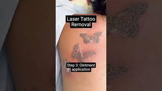 Laser Tattoo Removal