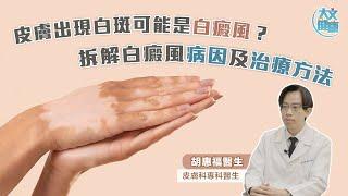 皮膚出現白斑可能是白癜風？ 拆解白癜風病因及治療方法