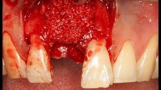 Single implant restoration with Dentium implant and rainbow™ Shine Block_Prof.Janghyun Paek