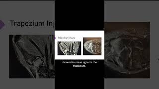 Trapezium Injury #sportsmedicine