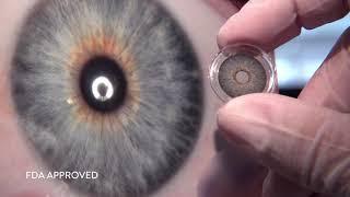 Can HumanOptics change “Human optics history” with its artificial iris?