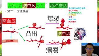 心脏血管系统 脑中风