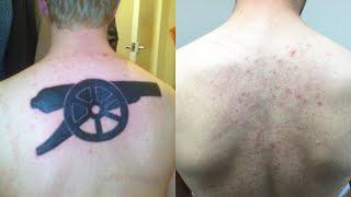 Laser Tattoo Removal -  Does laser tattoo removal hurt?