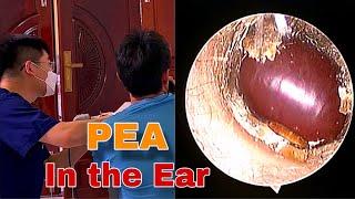 Remove The Pea From The Boy's Ear | Doctor Anh