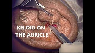 Removal of Keloid from the Auricle