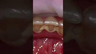 tartar removal teeth cleaning closeup #shorts #dentist #teethcleaning