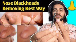 How to Remove Nose Blackheads and Whiteheads ? | Sahil Nagpal