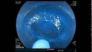 Gastric Peroral Endoscopic Myotomy / G-POEM