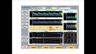 Natus TCD Webinar: Vasomotor Reactivity Testing