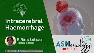 Intracerebral Haemorrhage by Dr Ajantha Keshavaraj