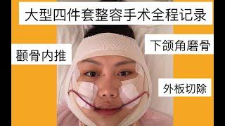 削骨磨骨轮廓四件套整容手术全程记录vlog | 我终于不是大饼脸了