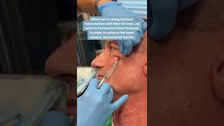 Filler for Men Using Cannula Technique