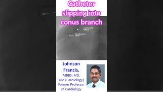 Catheter slipping into conus branch