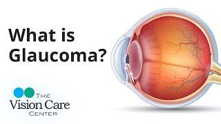 Dr. Weyer Explains: What is Glaucoma?