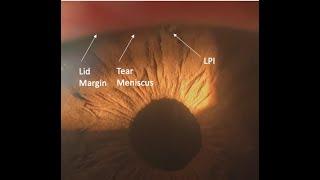 Laser Peripheral Iridotomy: Tips and Tricks (Malik Y. Kahook, MD)