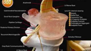 Lumbar Spinal Disc Model L4-5 by Dynamic Disc Designs Corp.