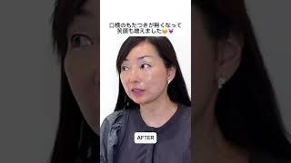 顔のたるみは内側からリフトアップ！️#東京美容外科 #美容整形 #フェイスリフト #スマスリフト