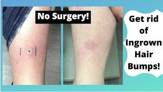 Dermatofibromas Removal – Get rid of hard scars!