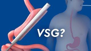 Vertical Sleeve Gastrectomy