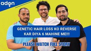 Genetic hair loss reversal 6 months by adon hair care .