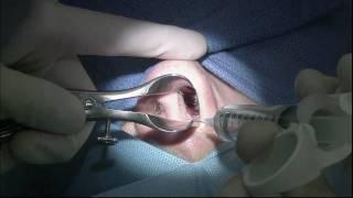 Septoplasty (GRAPHIC) - Deviated Septum Surgery