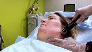 Vaser Liposuction for the Chin