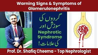 Warning Signs & Symptoms of Glomerulonephritis & Nephrotic Syndrome #proteinuria #nephroticsyndrome