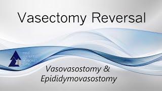 Vasectomy Reversal - How It's Performed, Including Vasovasostomy and Epididymovasostomy