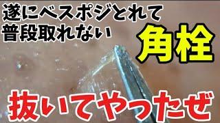 【角栓抜き】いつも取るのが難しい左鼻！ベスポジ見つけて取れまくりよ！【大興奮】