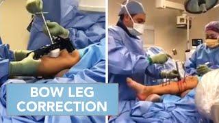 Bow Leg Correction Procedure | Inside the OR with Dr. Mahboubian