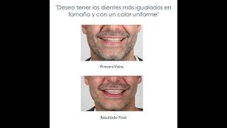 Eliminación de coronas y realineamiento gingival.