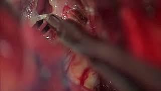 Clip reconstruction of ruptured AComA aneurysm