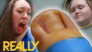 Gross Ingrown Toenail Removal Makes Friend Pass Out! | The Toe Bro