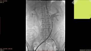 Ankura AAA stent graft system case video