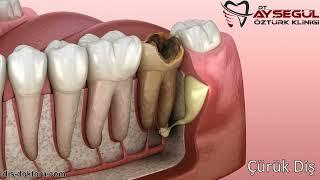 Tooth caries