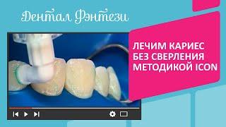  Лечим кариес без сверления методикой ICON