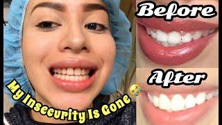 I GOT SURGERY?! | CROWN LENGTHENING EXPERIENCE