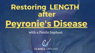 Restoration Surgery for Peyronie's Disease with Penile Implant