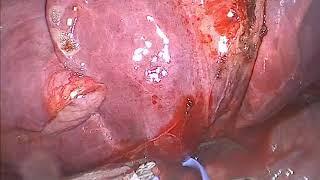 VATS Bilobectomy of RU+RML on a 27 Year-Old Patient Post Chemo/Radiation