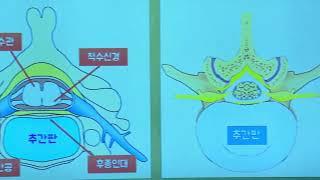 TV메디컬약손 척추질환의 원인과 치료 - 대구우리들병원 신경외과 전문의 이신영 진료원장
