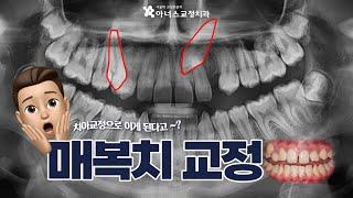 숨어있는 매복치아,  교정치료로 가능할까?