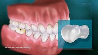 Dental Crown