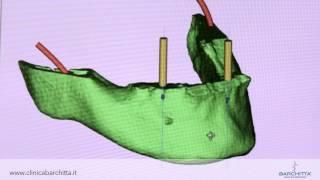 La tecnica "All on Four" - Impianto dentale in un giorno