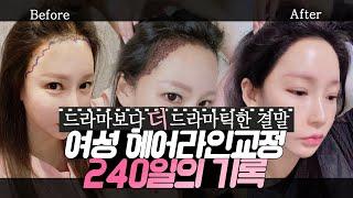 [재업]드라마보다 더 드라마틱하다! 여성 헤어라인교정 240일간의 기록⏰ㅣ다나성형외과DANAㅣ헤어라인교정