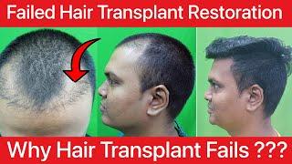 BEST HAIR TRANSPLANT RESULTS in 6 Months | Failed Hair Transplant Restoration |