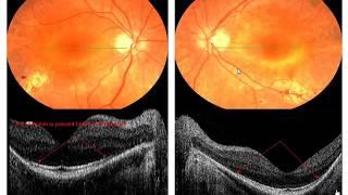 How to Read an OCT Image - with Dr. Jerome Sherman