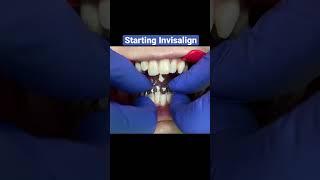 Adult Invisalign