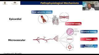 ASPETTI FISIOPATOLOGICI DEL MICROCIRCOLO: UN MECCANISMO CRUCIALE NELLA CARDIOPATIA ISCHEMICA